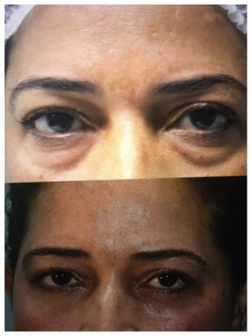 blefaroplastia2